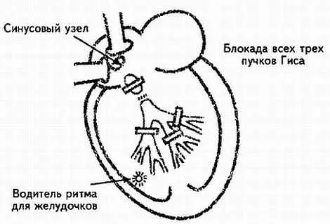 Рис 66 Дистальная атриовентрикулярная блокада Итоги раздела 52 1 - фото 66