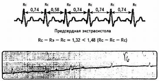 Рис 74 Неполная компенсаторная пауза Если учесть что - фото 74