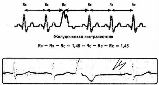 Рис 75 Полная компенсаторная пауза 3 Топика предсердных экстрасистол - фото 75