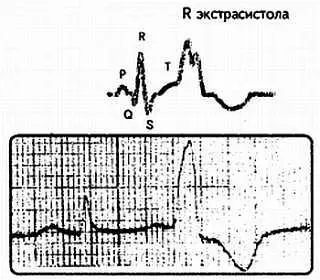 Рис 78 Экстрасистола типа Rна Т 8 Монотонные и политопные экстрасистолы - фото 78