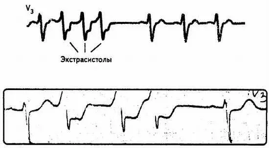 Рис 81 Групповые экстрасистолы 10 Алгоритмическая экстрасистолия В ряде - фото 81