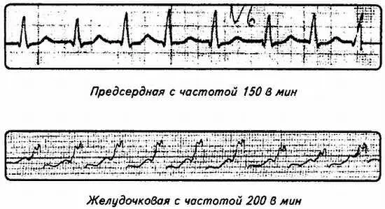 Рис 83 Пароксизмальные предсердная и желудочковая тахикардии При - фото 83