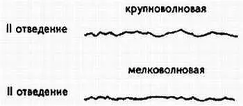 Рис 91 Крупноволновая и мелковолновая формы фибрилляции желудочков ГЛАВА 7 - фото 91