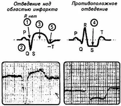 Рис 95 ЭКГ признаки инфаркта миокарда ЭКГпризнаки инфаркта миокарда 1 - фото 95