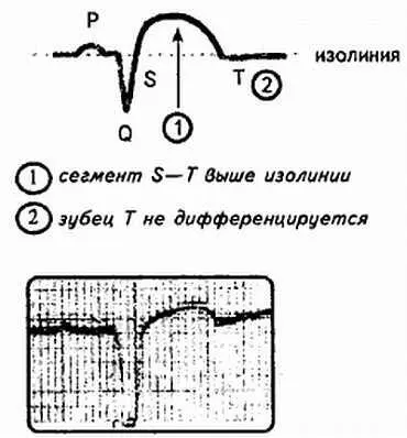 Рис 96 Острая стадия инфаркта миокарда 13 дня 13 недели длительность - фото 96