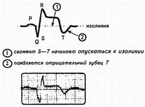 Рис 97 Подострая стадия инфаркта миокарда 13 недели 3 месяца - фото 97