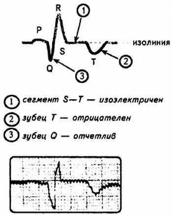 Рис 98 Стадия рубцевания инфаркта миокарда Последовательность описанных - фото 98