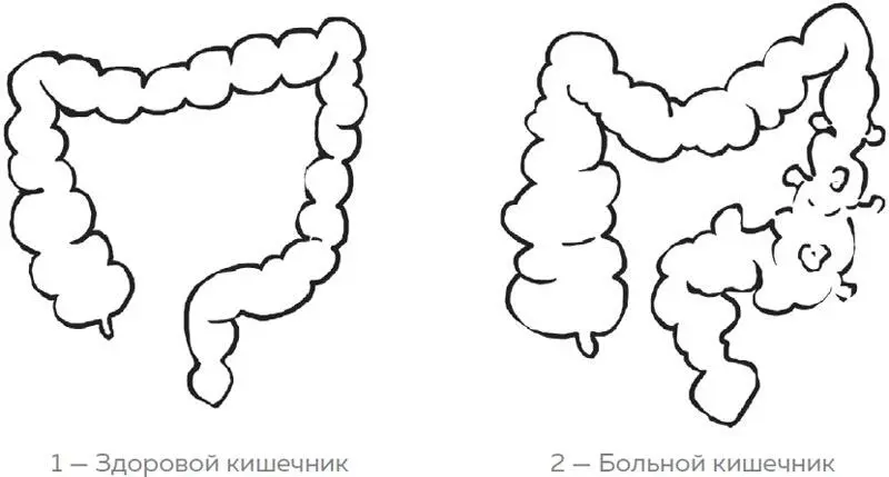 Рис 3 Здоровый и больной кишечник Так как же наш друг теряет форму Весь - фото 39