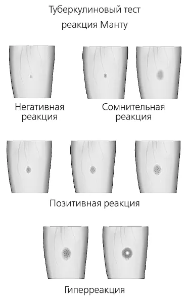 Реакция Манту Позитивная реакция Манту означает что человек контактировал с - фото 47