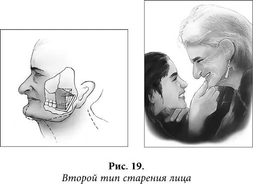 Первый тип это типичный вариант биомеханического старения лица свойственный - фото 16