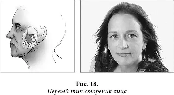 Первый тип это типичный вариант биомеханического старения лица свойственный - фото 17