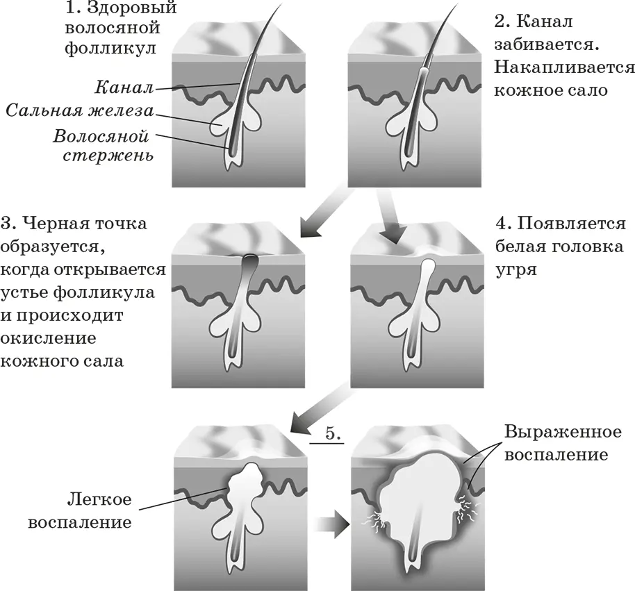 Образование акне Взрослая форма акне может быть вызвана стрессом - фото 8