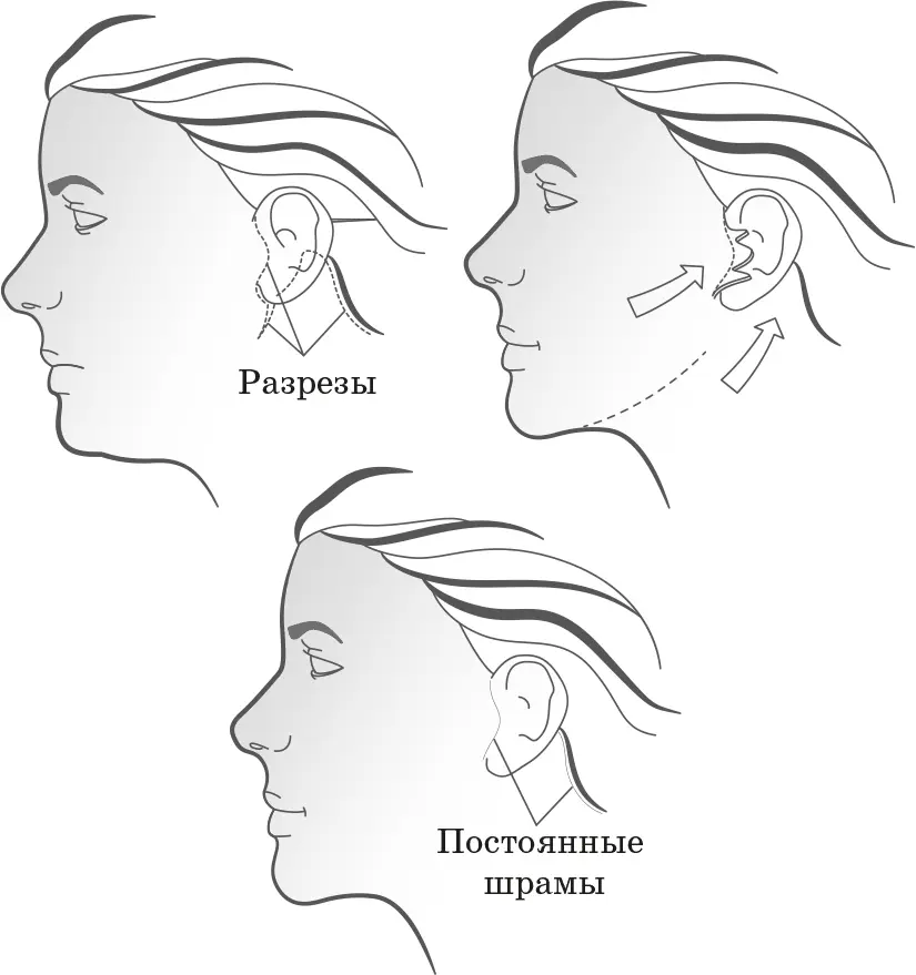 Фейслифтинг Однако если фейслифтинг не входит в ваши планы на будущее можно - фото 12