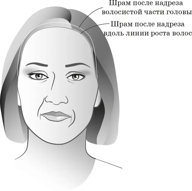 Шрамы после лифтинга бровей Другой способ открытого лифтинга бровей - фото 25