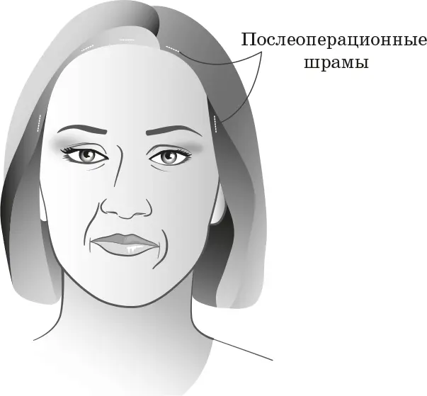 Шрамы после эндоскопического лифтинга бровей Этот вариант может показаться вам - фото 26