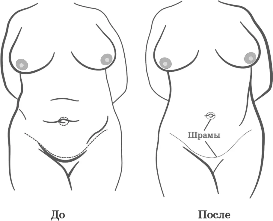 Абдоминопластика Интересное наблюдение хотя абдоминопластика является одной из - фото 29