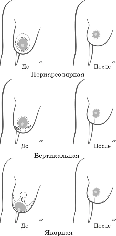 Типы мастопексии Шрамы после подтяжки груди различаются по длине в зависимости - фото 31