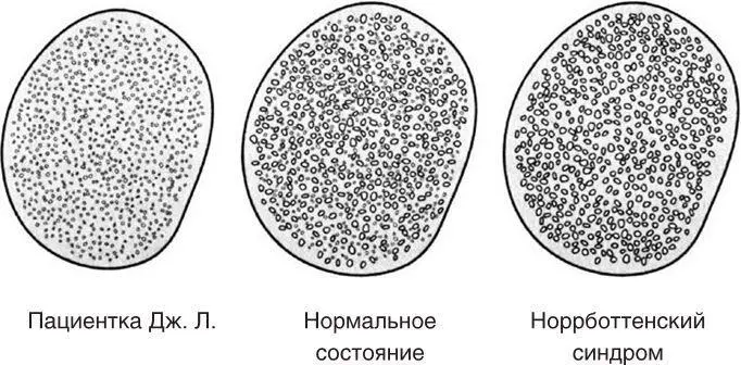 Рис32 Биопсия икроножного нерва пациентки Дж Л Заметьте что в икроножном - фото 19
