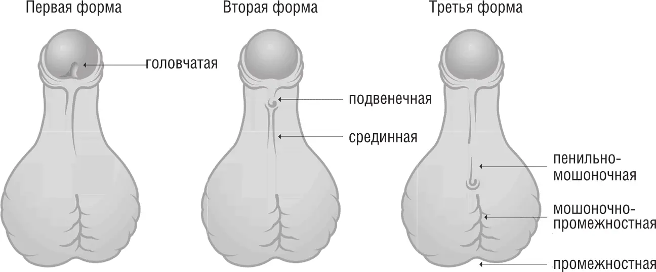 Три формы гипоспадии В ЧЕМ ОНА ЗАКЛЮЧАЕТСЯ В том что наружное - фото 16