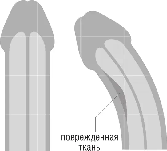 Болезнь Пейрони А ЧТО МОЖЕТ ВЫЗЫВАТЬ ЭТИ МИКРОВОСПАЛЕНИЯ Например - фото 18