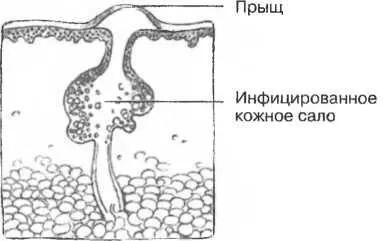 Рисунок 30 ПрыщиЕсли пора и верхняя часть волосяного мешочка закупориваются - фото 30