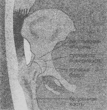 Нормальный тазобедренный сустав Сустав пораженный остеоартритом Причины болей - фото 1