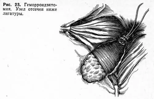 Точно по описанной методике иссекают снаружи внутрь остальные два внутренних - фото 33