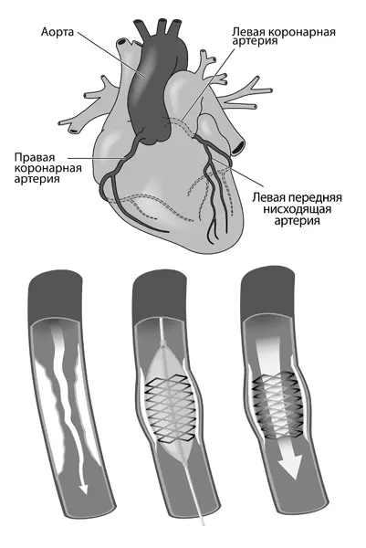 Рис 2 Новые стенты называются покрытыми стентами Такие стенты покрываются - фото 25