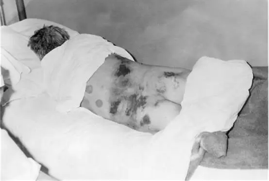 Рис 17 Элементы геморрагической сыпи при лихорадке Эбола Клиническая картина - фото 26