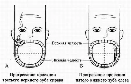 Рис 109 Прогревание зон соответствия зубам при зубной боли А минимоксой - фото 102