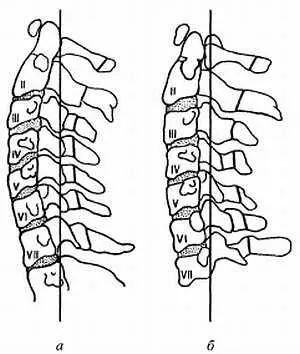 Физиологический а и сглаженный б шейный лордоз К этому нужно добавить - фото 34