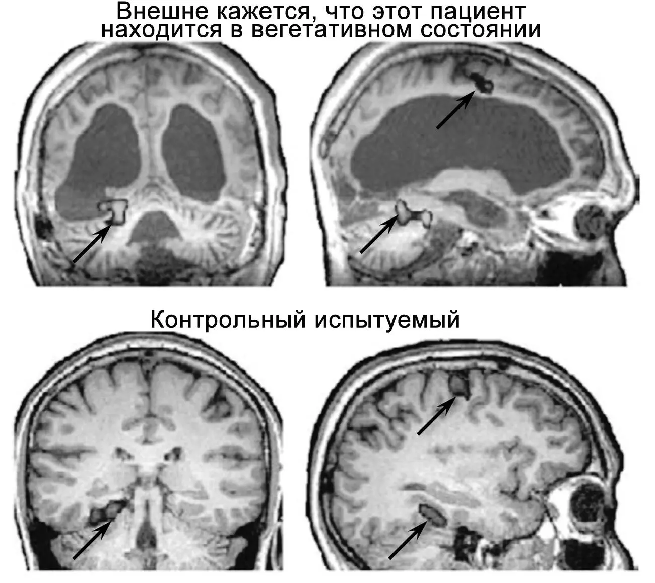 Рисунок 30Некоторые пациенты внешне демонстрирующие признаки вегетативного - фото 33