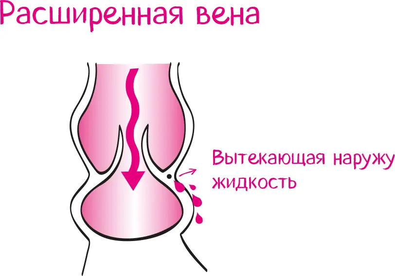 Вот вам и опухшие ноги По высоте на которой опухает нога вы определите где - фото 69