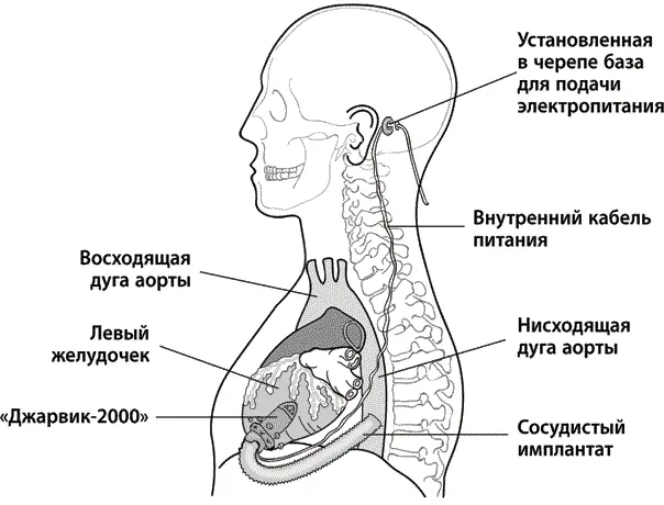 Рис 5 Установленный в левый желудочек прибор Джарвик2000 операция - фото 5