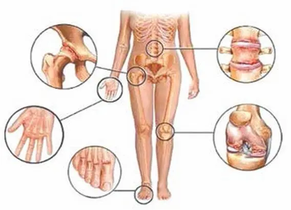 Рис 9 Отложение солей В медицине есть понятие солевое отложение это - фото 80