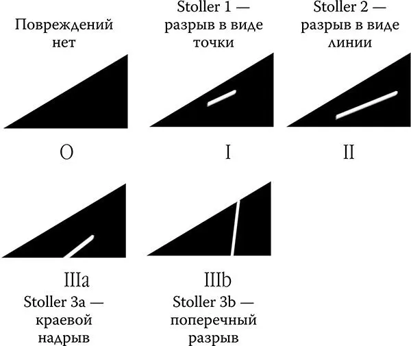 Научная классификация повреждений мениска Артроскоп это гибкая трубочка с - фото 2