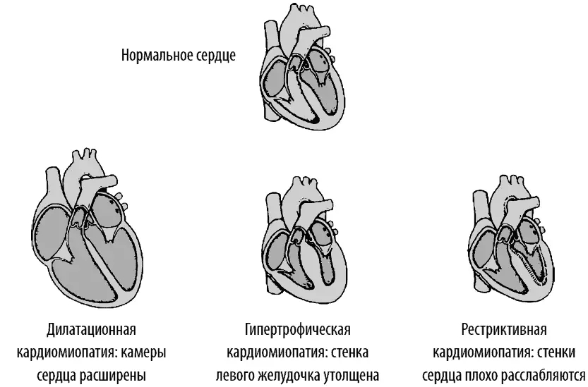 У пациента быстро нарастают симптомы сердечной недостаточности одышка при - фото 93