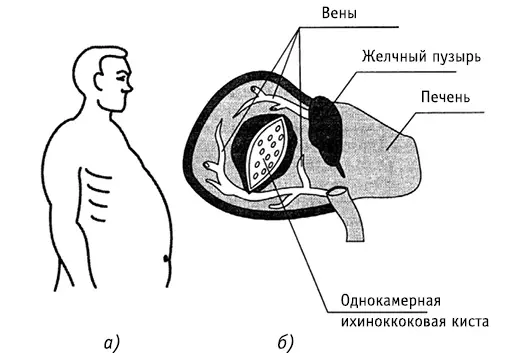 Рис 15Больной эхинококком а Однокамерная эхинококковая киста в печени - фото 17