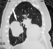Рис 13 Компьютерная томография сагиттальная реконструкция Рис 14 - фото 28