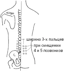Рис 11 а Вакуумпомощь при смещении дисков Рис 11 б Вакуумпомощь при - фото 17
