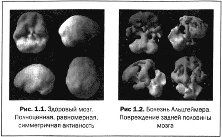 Давайте например подумаем вместе о болезни Альцгеймера которая без - фото 3