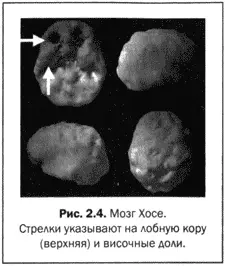 Понятно что мозг Хосе должен был иметь отклонения В прошлом он перенес ряд - фото 9