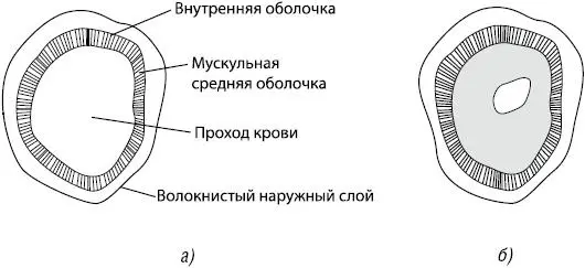 Рис 3 Схематическое изображение артерии в поперечном разрезе а здоровая - фото 3