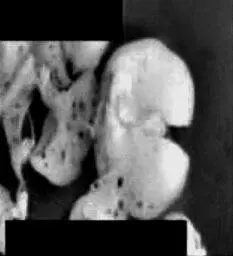 Рис 52Уменьшение очагов метастазирования в легких после питья католита Самое - фото 65