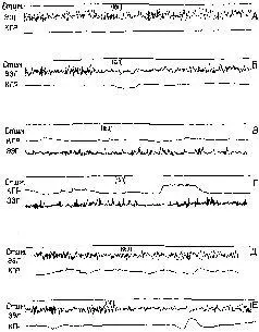Рис III1 А угашение ориентировочного рефлекса ЭЭГ и КГР на раздражитель - фото 34