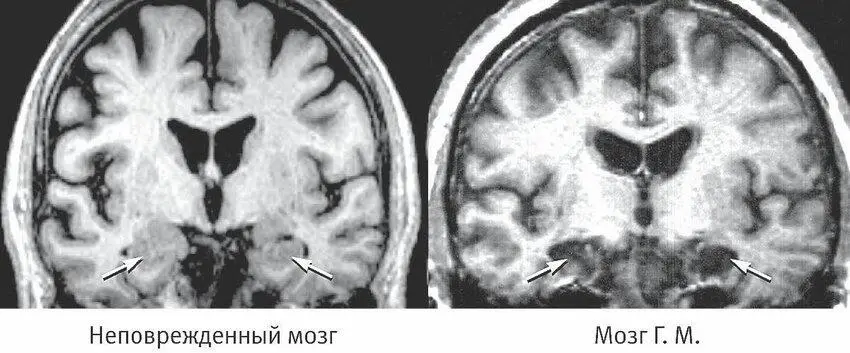 Рис 53Сравнение неповрежденного мозга и мозга пациента Г M после резекции - фото 27