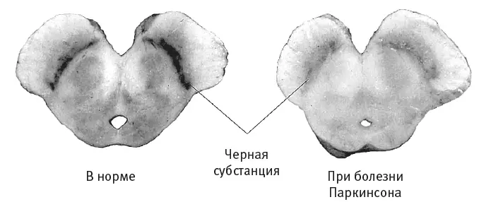 Рис 72Люди с болезнью Паркинсона теряют производящие дофамин нейроны темные - фото 37