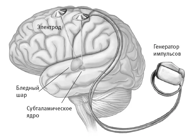Рис 73Глубокая стимуляция мозга Бледный шар парная подкорковая структура - фото 38