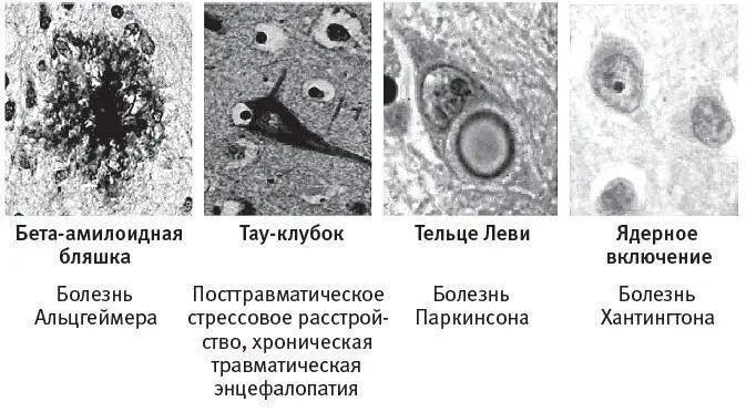 Рис 76Изза аномального фолдинга белки формируют в мозге агрегаты что - фото 41