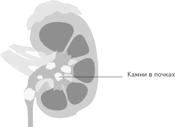 Большие камни в почках это без сомнения одна из самых болезненных вещей - фото 68